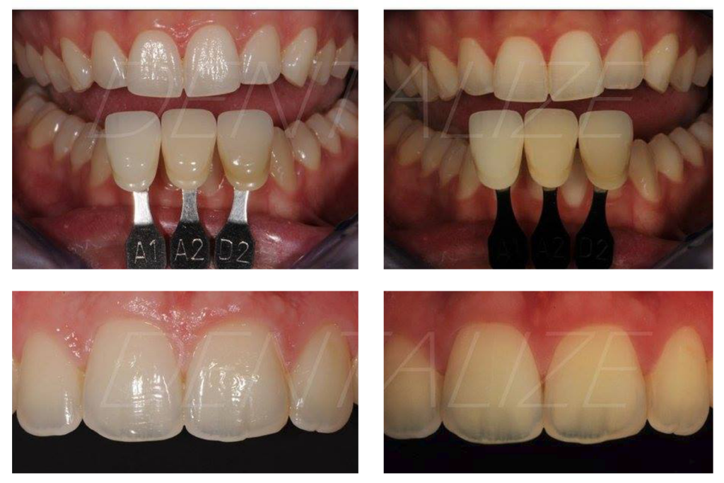 Color matching in prosthodontics