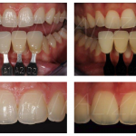 Color matching in prosthodontics